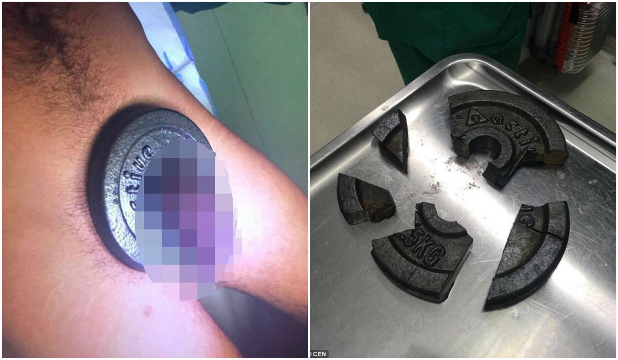 Pasiune dusă la extrem! A durat 3 ore ca pompierii să-i poată scoate greutățile de pe "bară"