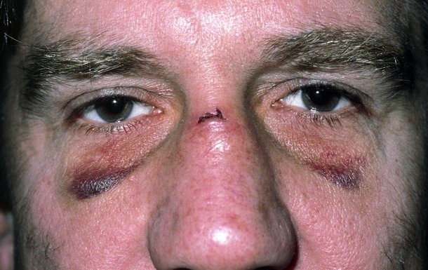 De ce nu este bine să-ți sufli nasul după ce ai fost lovit în el (VIDEO) De ce nu este bine să-ți sufli nasul după ce ai fost lovit în el (VIDEO)