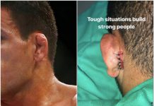 Un luptător UFC a trebuit să-și coase urechea la loc după luptă Un luptător UFC a trebuit să-și coase urechea la loc după luptă