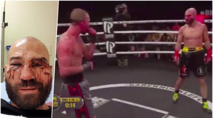 Vezi cum arată Artem Lobov, prietenul lui McGregor și adversarul său după o luptă de box fără mănuși! (VIDEO) Vezi cum arată Artem Lobov, prietenul lui McGregor și adversarul său după o luptă de box fără mănuși! (VIDEO)